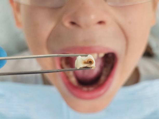 Best Emergency Tooth Extraction in Greenwich, OH
